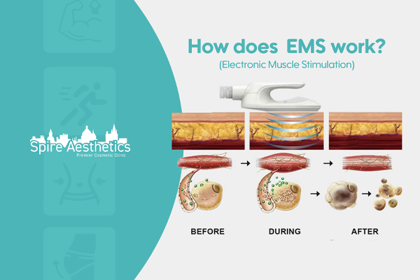 EMS treatment for post pregnancy weight loss treatment Shefford