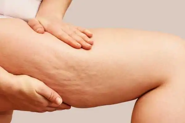 Image of woman showing leg with cellulite Shefford