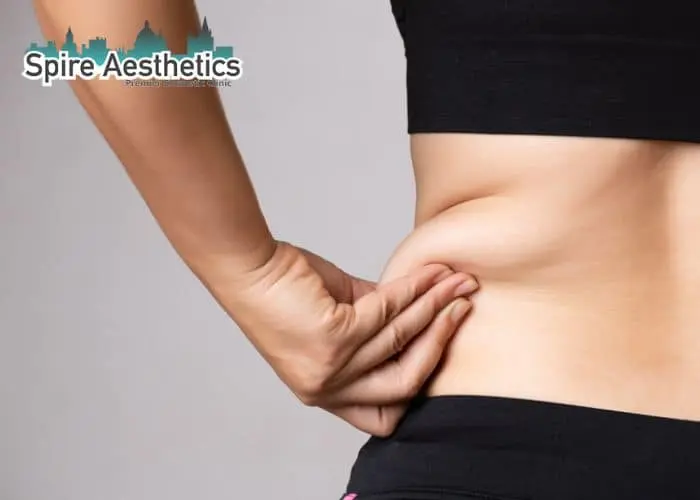 Image of woman pinching fat on their hips Shefford. Fat Freezing treatment