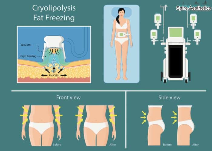 Image of diet and fat freezing combined for best results for Spire Aesthetics Shefford