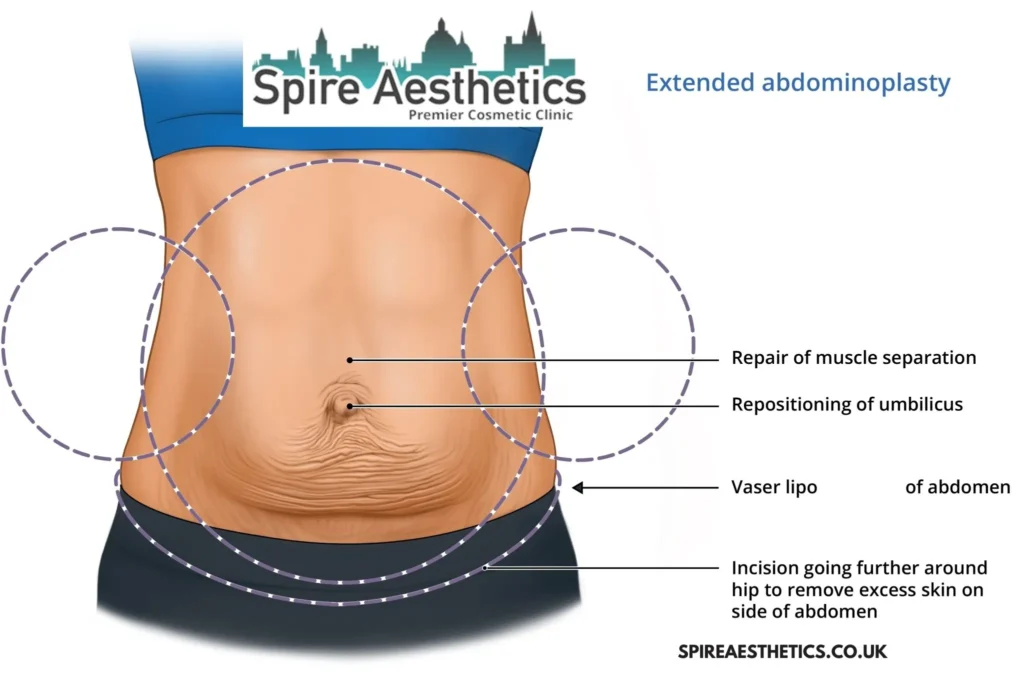 Understanding Loose Skin After Gastric Band Shefford Surgery and HIFU Treatment