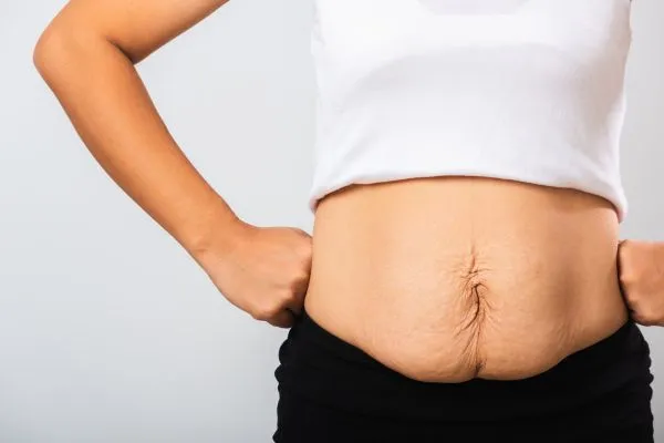 Image of a woman's stomach after weight loss with sagging skin following a gastric band Shefford