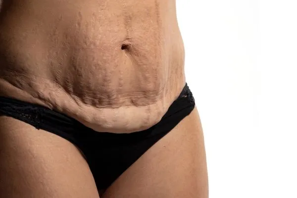 Image of womans stomach after weight loss injections Shefford showing saggy skin