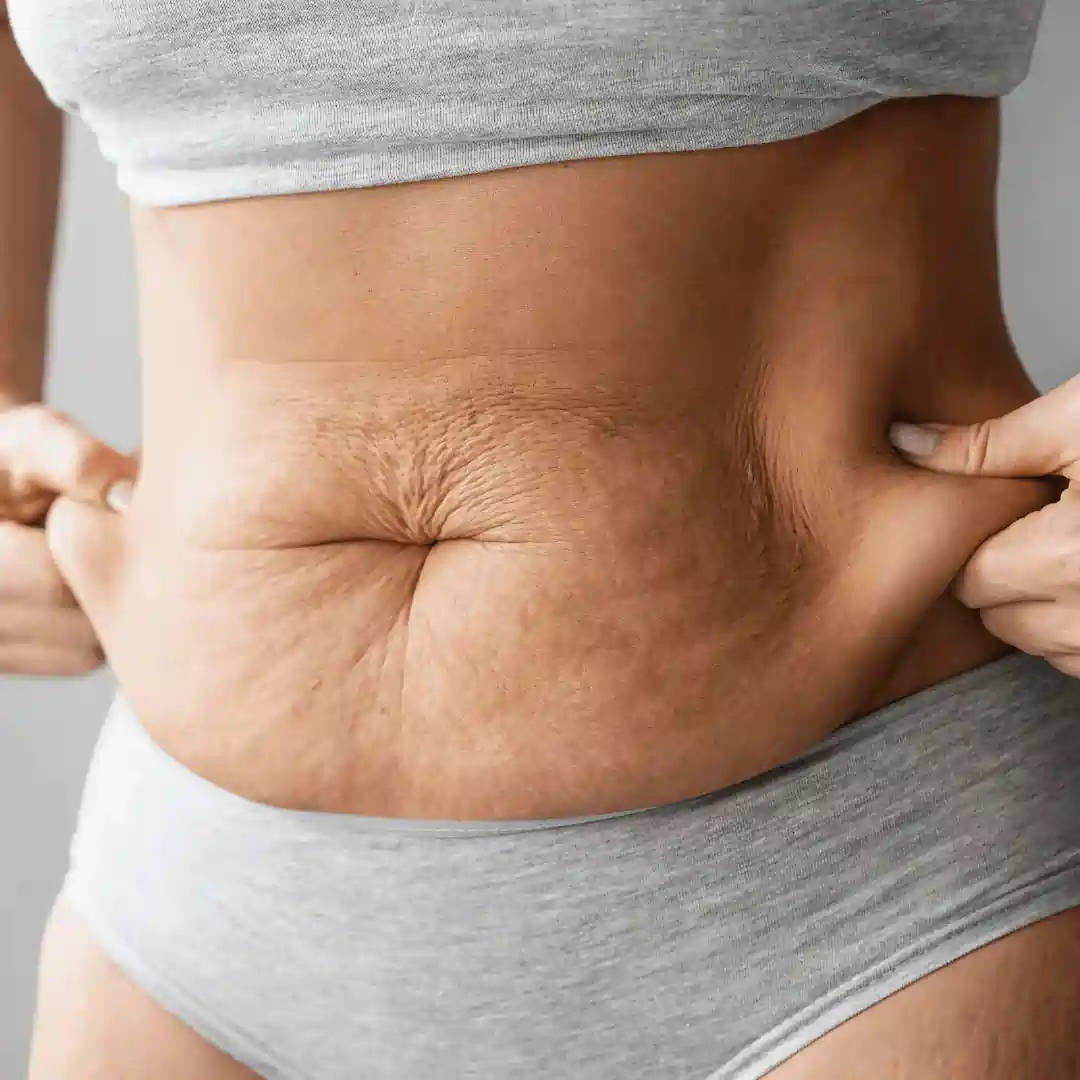 Is It Normal to Have Loose Skin After Pregnancy Shefford?
