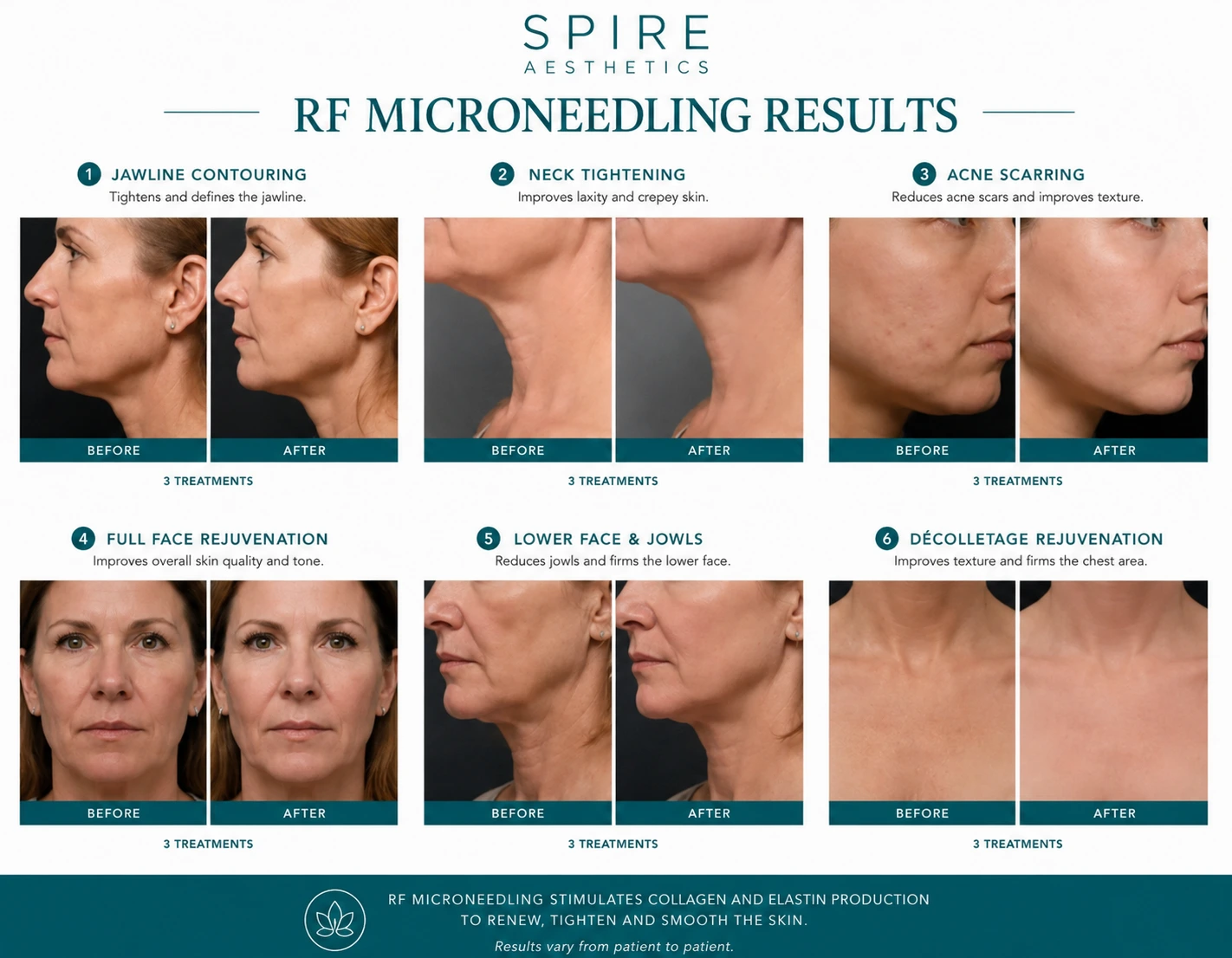 RF Microneedling Skin tightening Shefford results