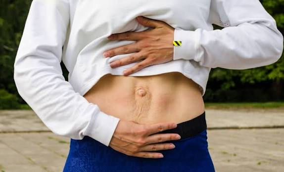When Could Diastasis Recti Be the Missing Piece of the Puzzle Shefford?